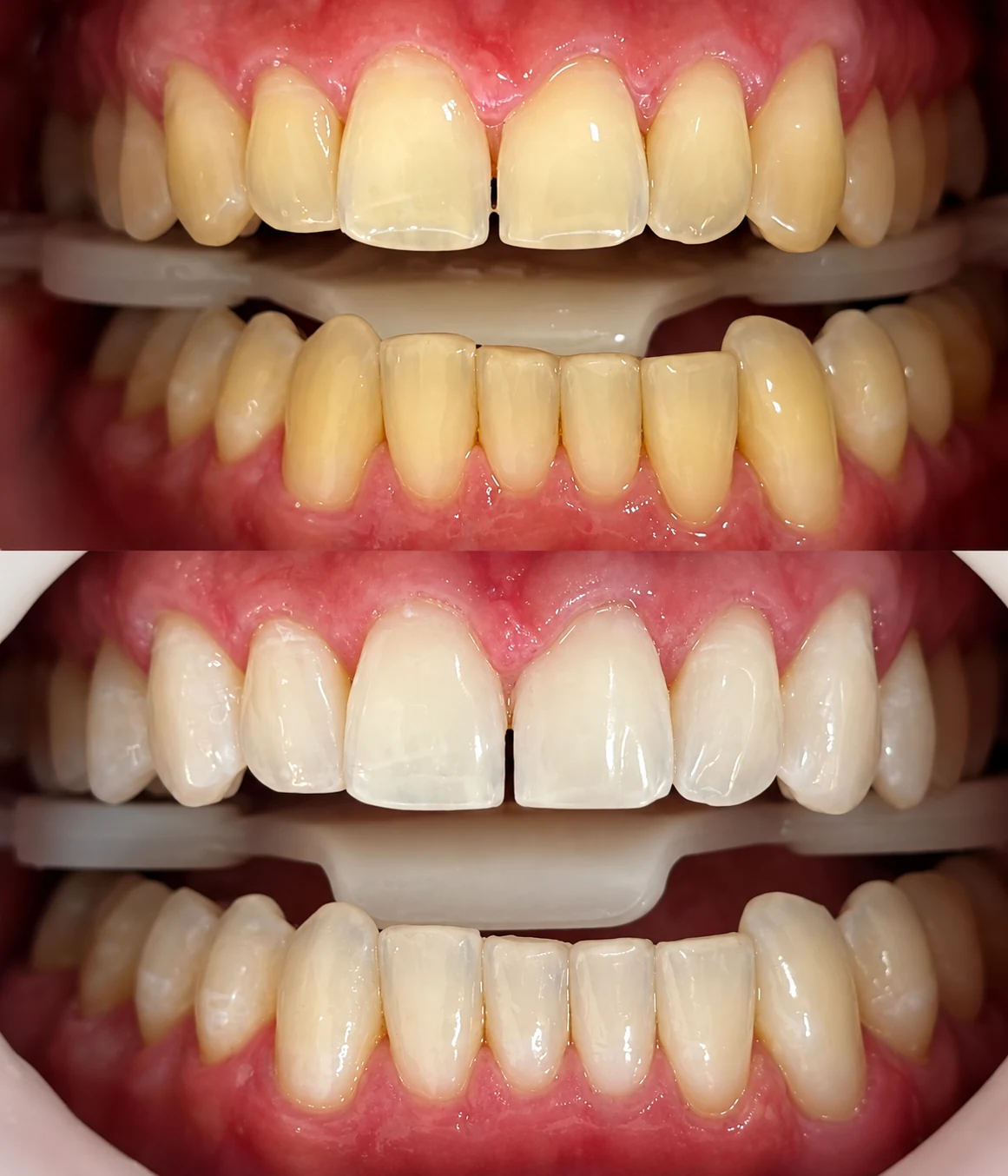 Espaço reservado para antes e depois de clareamento dental 1